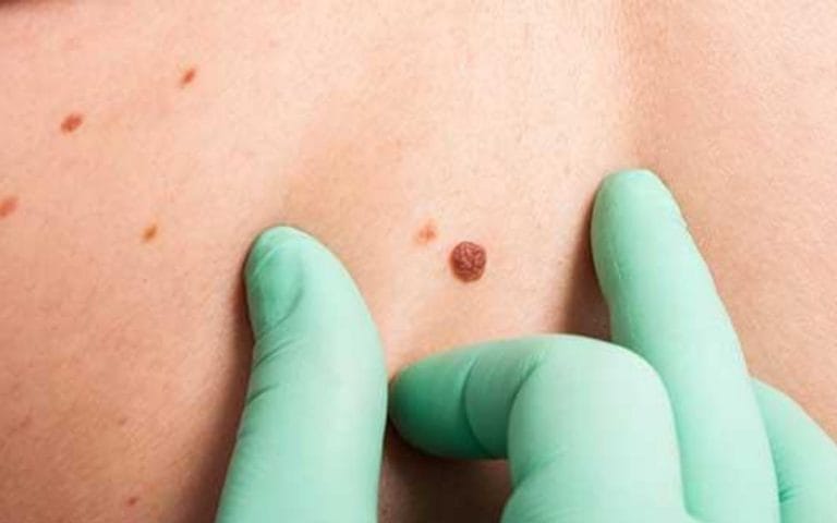 skin-cancer